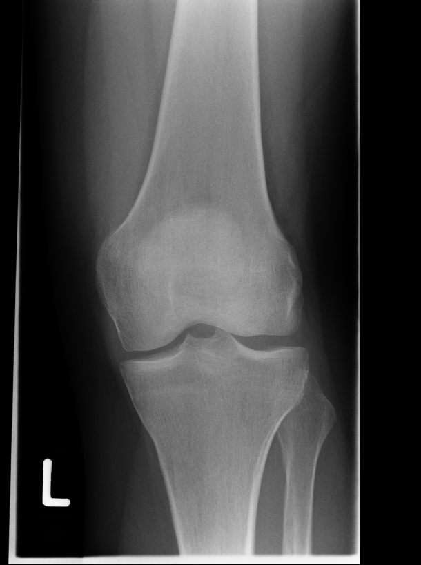 Артроз коленного сустава мениск. Рентгенограмма коленного сустава в норме. Деформирующий остеоартроз локтевого сустава рентген. Рентген левого коленного сустава норма. Коленный сустав рентген норма.