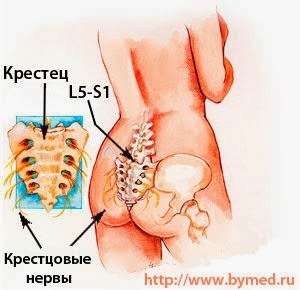 Выпирает, торчит копчик, деформация, загиб копчика