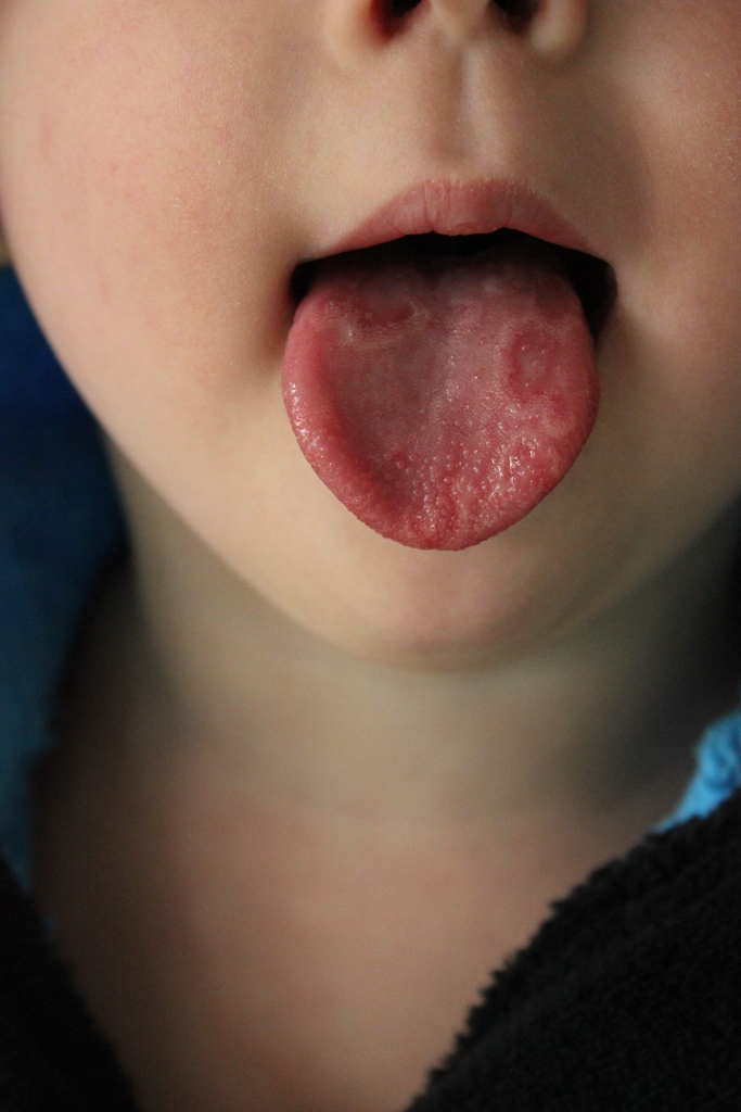 Пятна на языке у ребенка: причины, лечение, фото